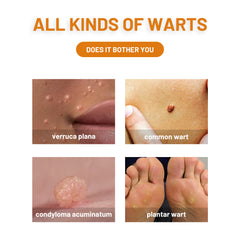 Supplied wart-care artwork illustrating several types of skin growths