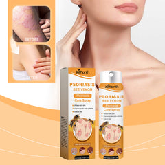 Psoriasis care spray for dry itchy-feeling skin