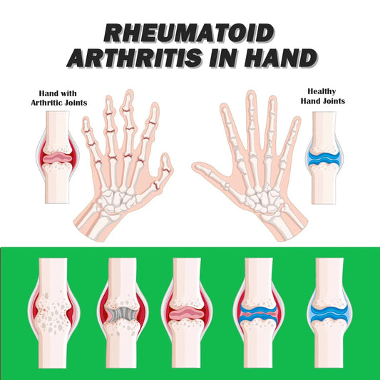 Illustration showing rheumatoid arthritis in hand and healthy hand joints, relevant for arthritis pain relief discussion.