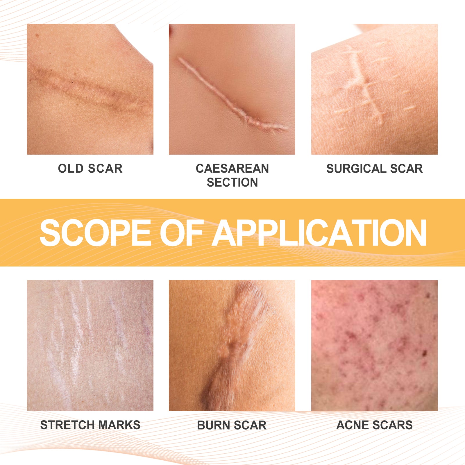 Bee venom spray for mature scar appearance