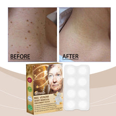 Microneedle-style wart care patch for targeted use