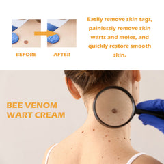 Bee venom wart cream smooth skin care positioning