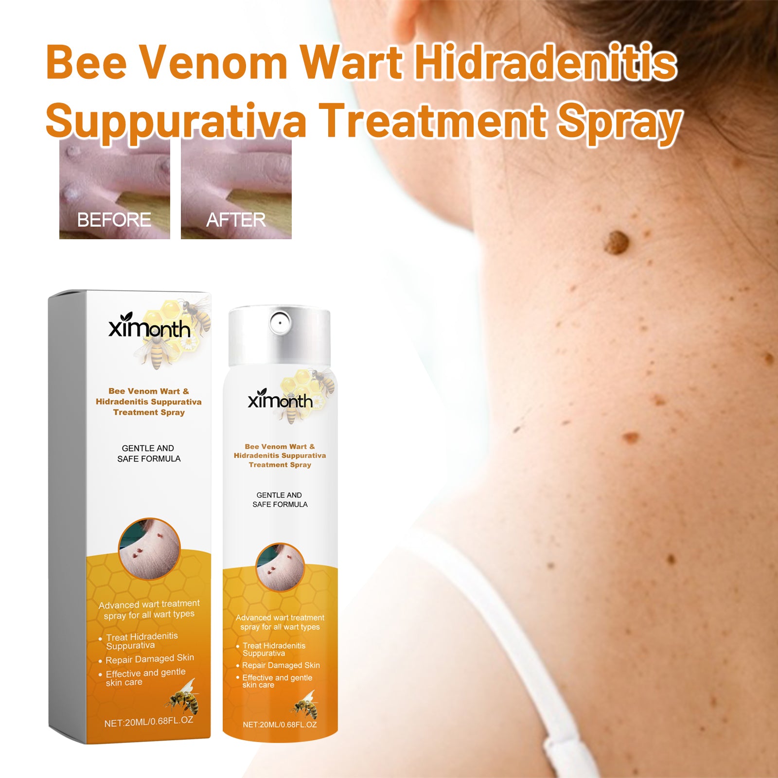 Wart spray packaging beside a close-up skin-care scene