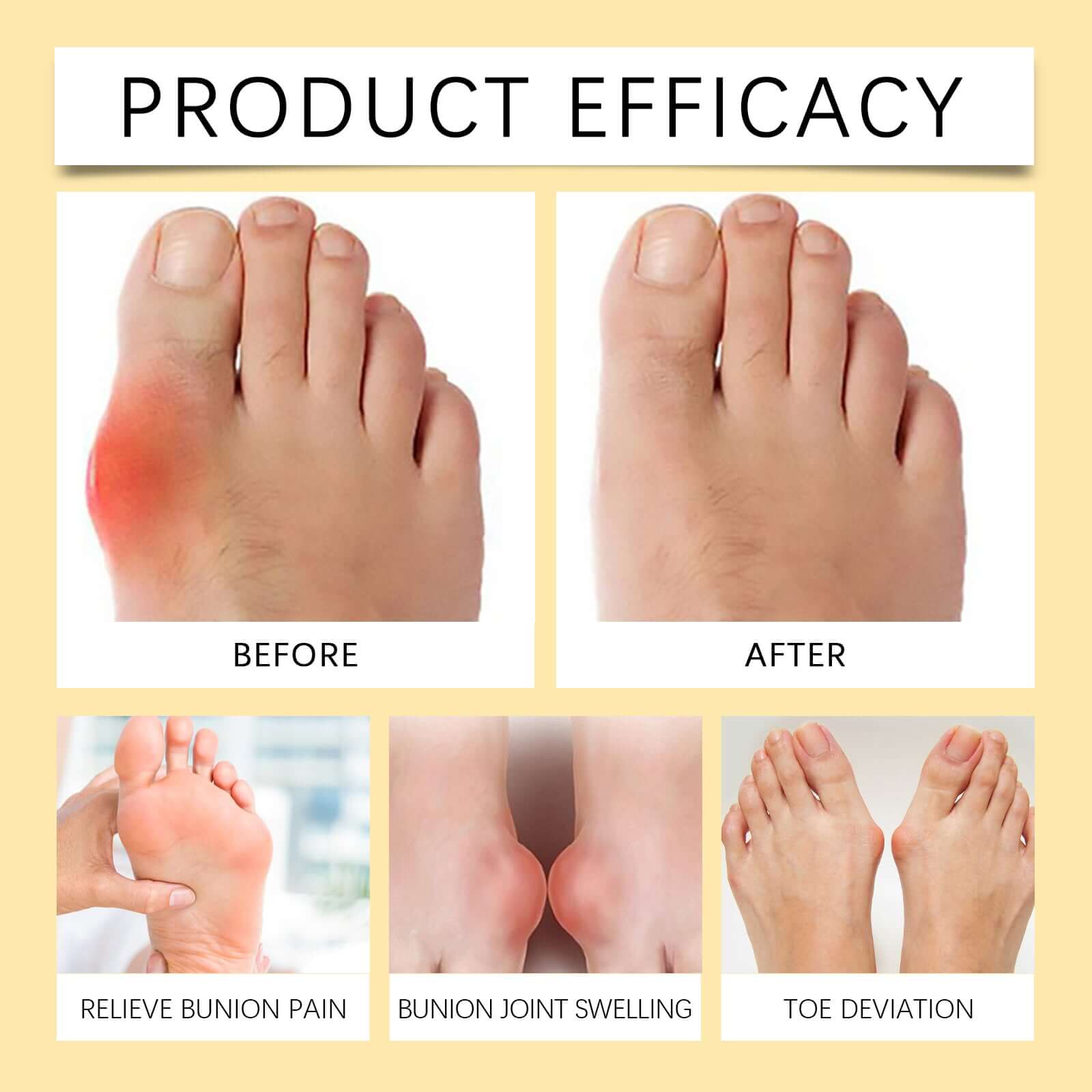 Before and after images showing effectiveness of bee venom foot pain relief cream for bunion care and pain reduction.