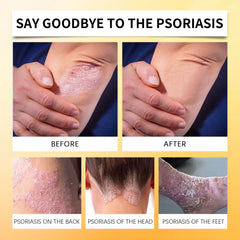 Bee venom and botanical psoriasis spray ingredients